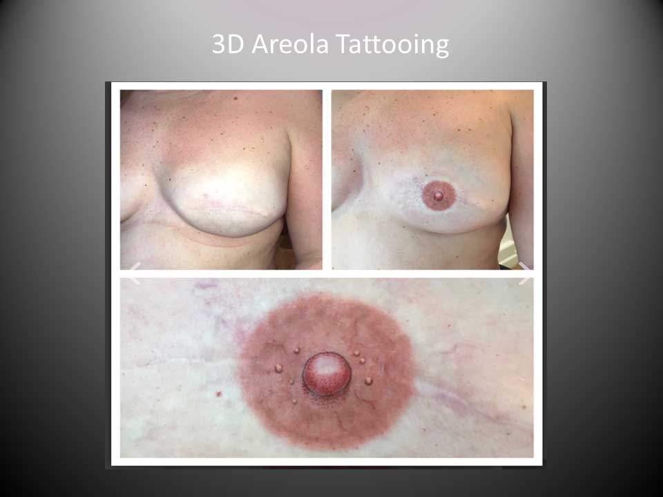 3d areola tattooing