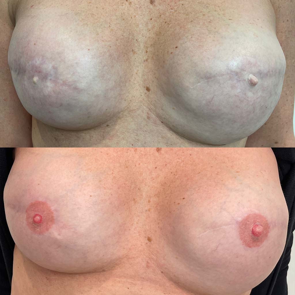 Cosmetic enhancement
